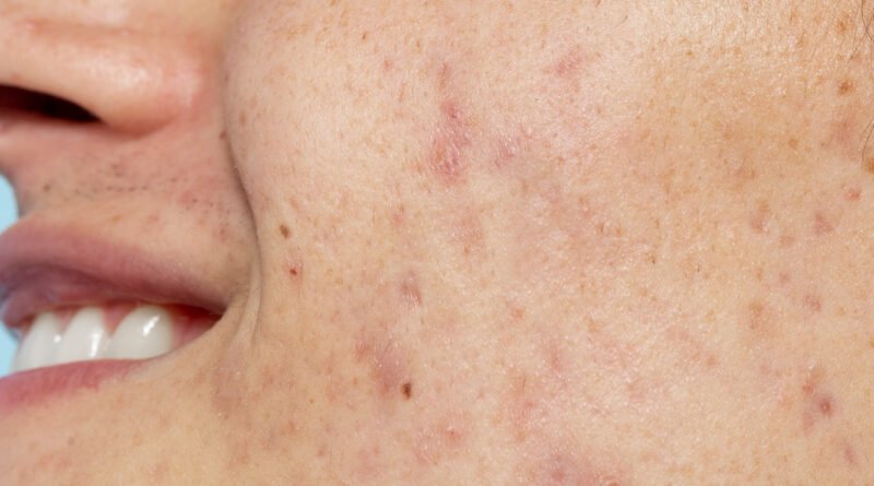 pele acneica como tratar e prevenir