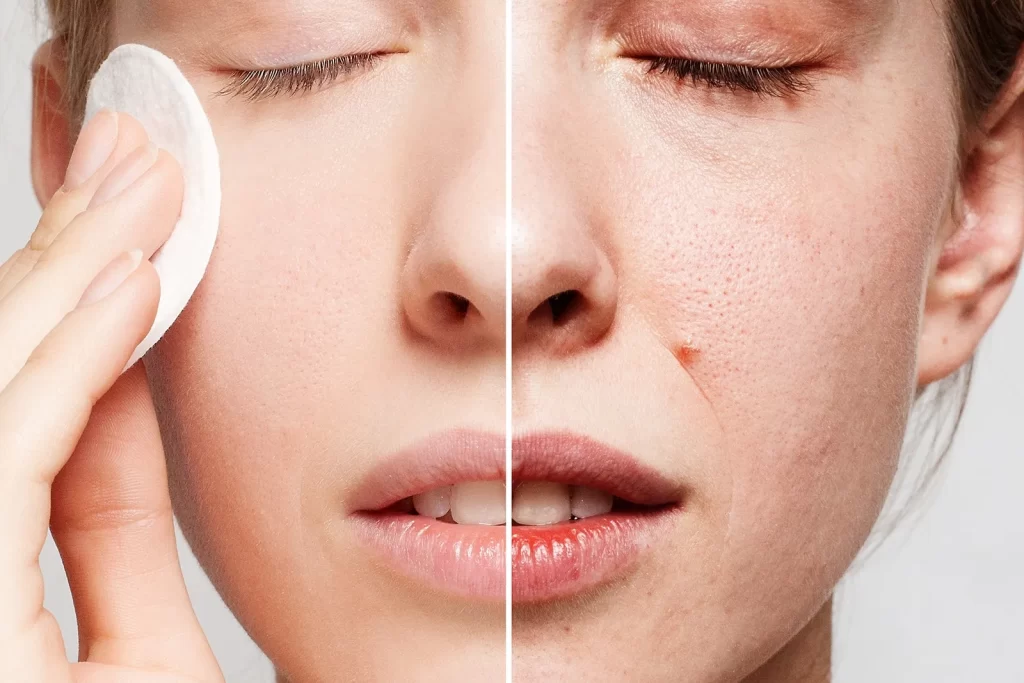 Vitacid clareia? Saiba se é melhor que Azelan e como usar 2 vitacid clareia manchas de pele de verdade?