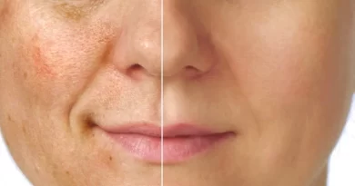 vitacid ou azelan