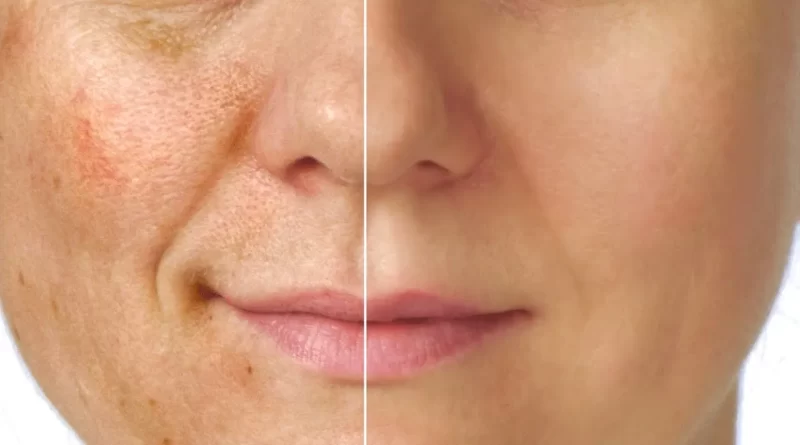 vitacid ou azelan